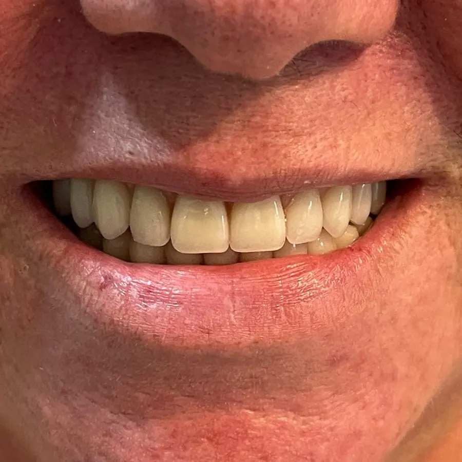 Sorriso de paciente reabilitada com prótese no Espaço Odontológico, ao fim do tratamento